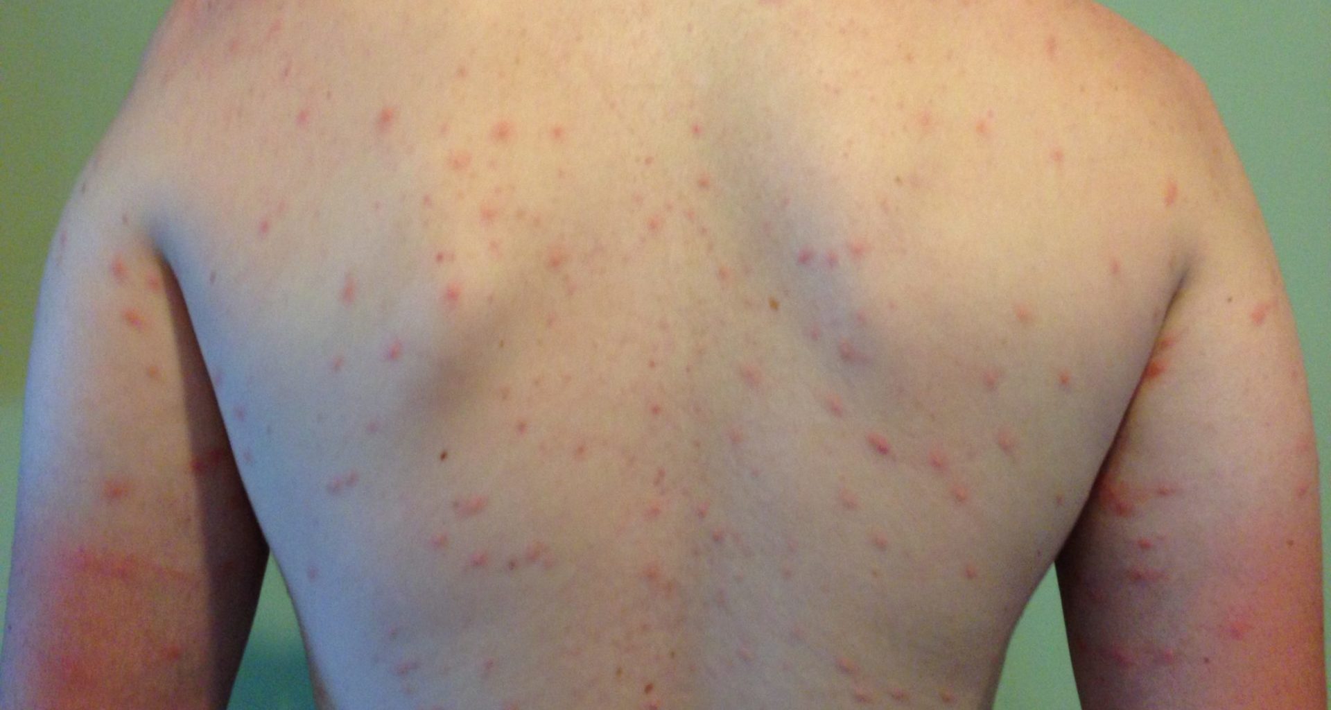 swimmers itch bumps