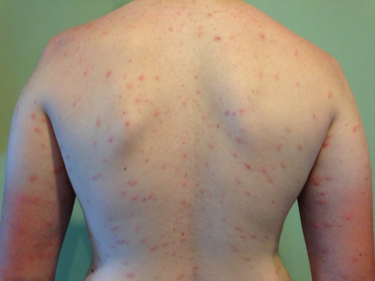 infected swimmers itch